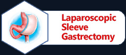 Laparoscopic Sleeve Gastrectomy